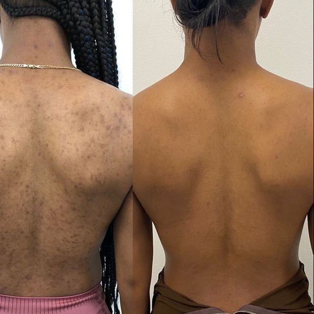 Before and after comparison of a person's back with visible acne, labeled 'Before' and 'After' 